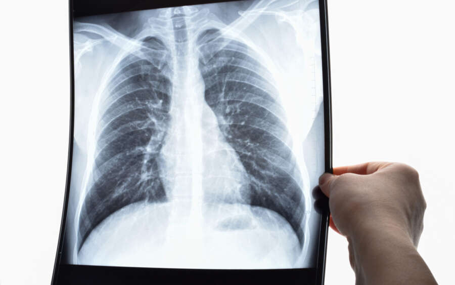 Lungen roentgenbild 1800px